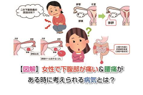 【図解】女性の右の下腹部に痛みがある時に原因として考えられる病気は？