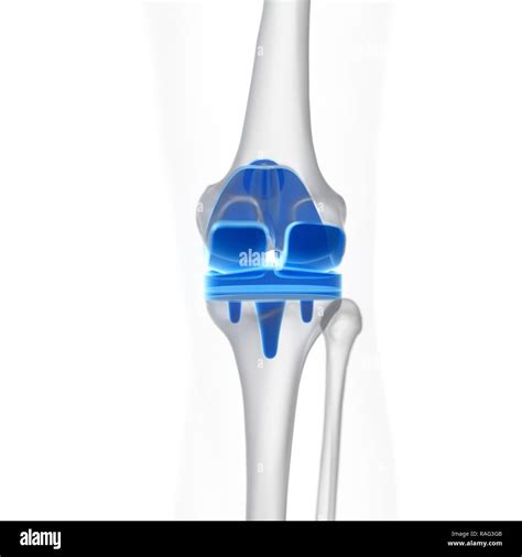 Illustration Of A Knee Replacement Stock Photo Alamy