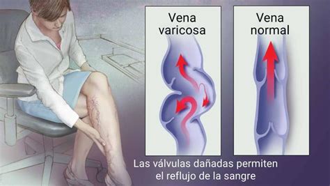 Tratamientos Naturales Para Eliminar Las Venas Varicosas