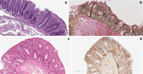 A Collagenous Colitis He Stained Slide The Surface Epithelium Is Download Scientific Diagram