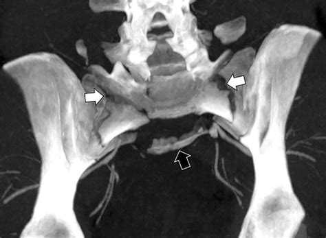 CT Of Sacral Fractures Classification Systems And Management