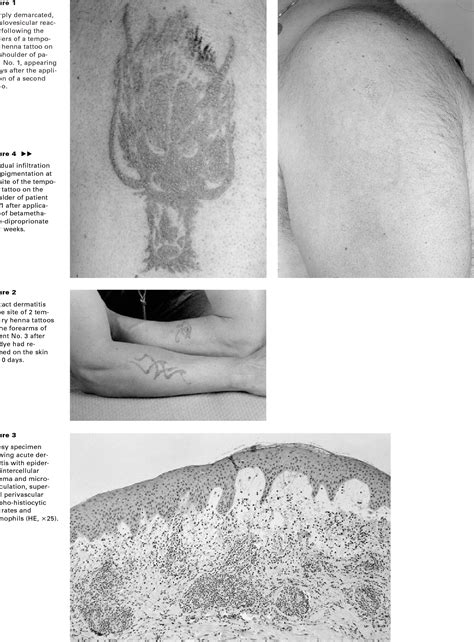 spongiotic dermatitis | Semantic Scholar