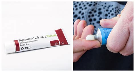 Pomada Para Eczema Na Pele - Pomada Para Dermatite Seborreica: Nomes E Métodos De Aplicação – AELTI