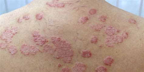 How to Tell If Your Rash Is Psoriasis