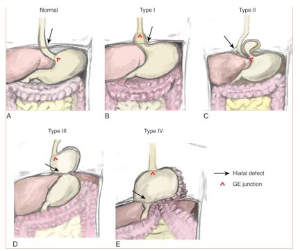 Laparoscopic Paraesophageal Hernia Reduction With Two Point Fixation