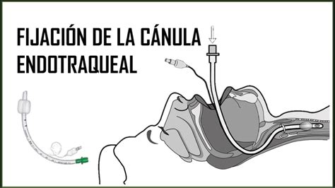 Fijación de cánula endotraqueal y CPC YouTube