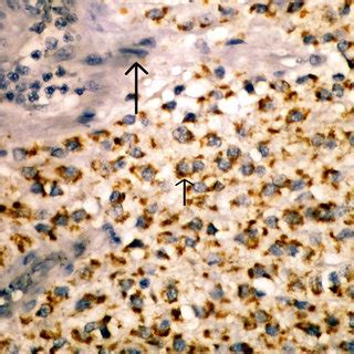 Positive Staining In Tumor Cell S Cytoplasm For Maspin Short Arrow