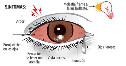 Conjuntivitis U Ojo Rojo No Te Preocupes No Es Tan Grave