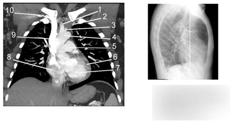 Diagram Of Coronal Contrast Enhanced Chest W Mediastinal Windows 3