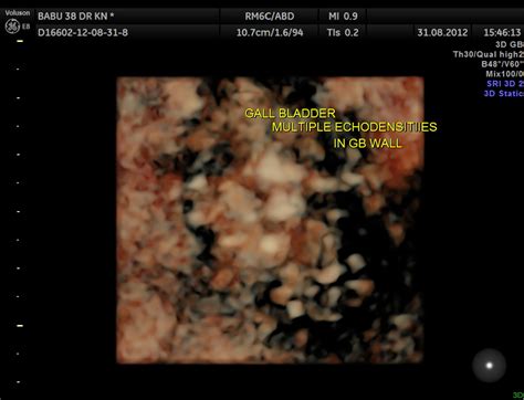 Cholesterolosis Of The Gallbladder Strawberry Gall Bladder Looking