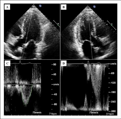 Figure 1 From Low Left Ventricular Outflow Tract Velocity Time Integral Is Associated With Poor