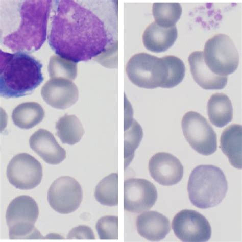 A B Bone Marrow Findings Download Scientific Diagram