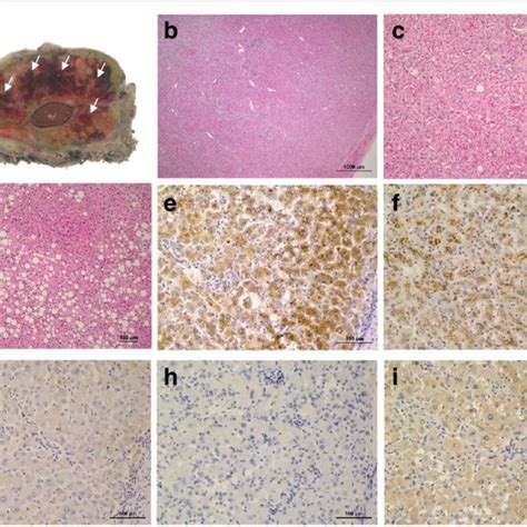 Histopathological Findings Of The Resected Specimen A Macroscopically