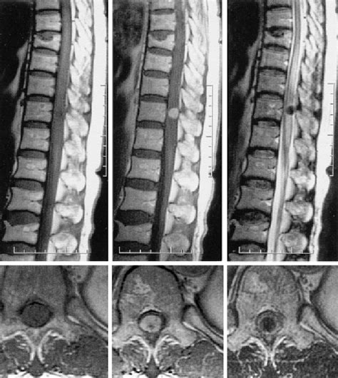 Figure From Solitary Fibrous Tumor Of The Thoracic Spinal Cord