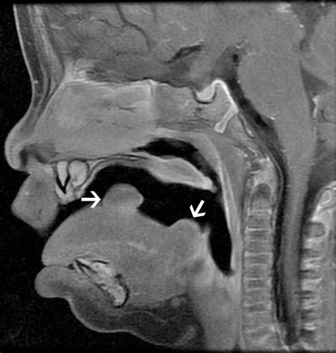 Congenital Oral Masses An Anatomic Approach To Diagnosis Radiographics