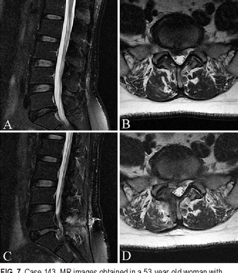 Figure From Percutaneous Transforaminal Endoscopic Discectomy