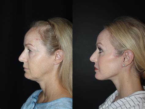 Neck Lift Before And After Gallery Cc Plastic Surgery