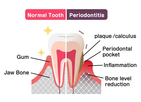 Periodontal Disease Stages Symptoms And What To Expect