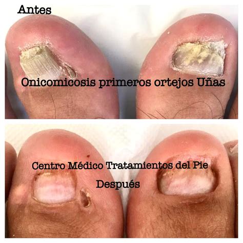 ONICOMICOSIS Hongo en uñas del pie Centro Médico Tratamientos del Pie