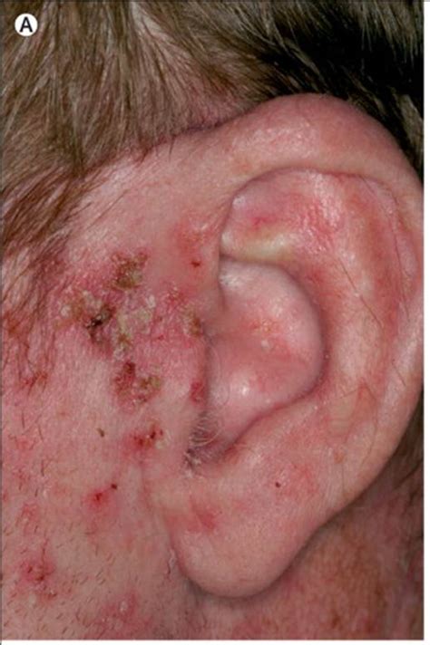 Melanoma Skin Cancer Ear