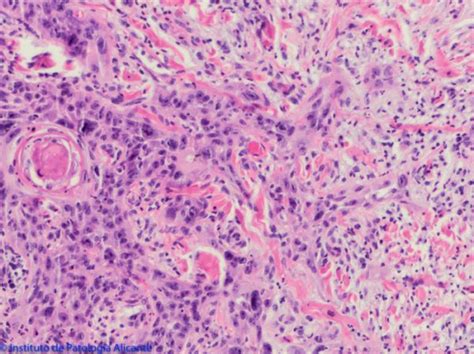 Carcinoma Escamoso Cutáneo Instituto De Patología Alicante