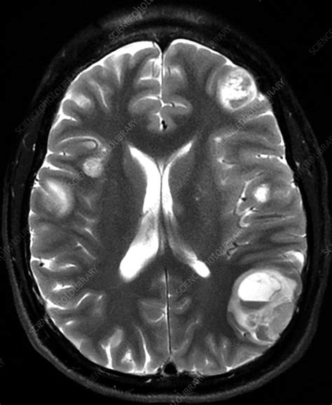 Melanoma Metastatic to Brain, MRI - Stock Image - C039/4211 - Science ...