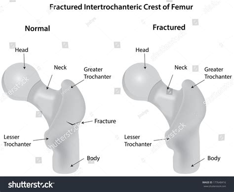 Femur Intertrochanteric Crest