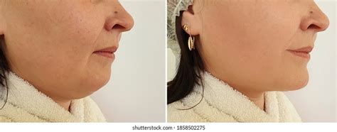 Woman Double Chin Before After Treatment Stock Photo 1858502275 | Shutterstock