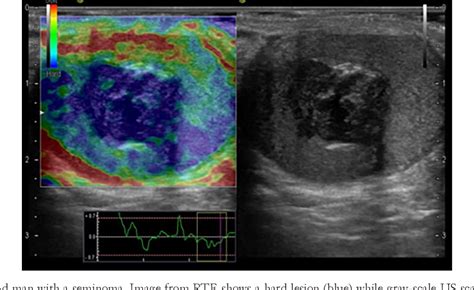 Figure 1 From Does Multiparametric Us Improve Diagnostic Accuracy In