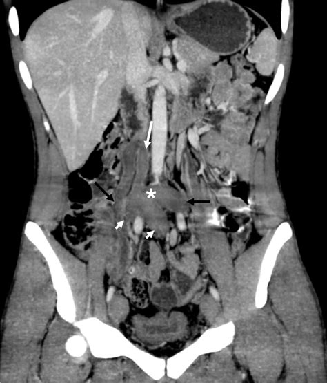 Computed tomography angiography, coronal reconstruction, shows a ...