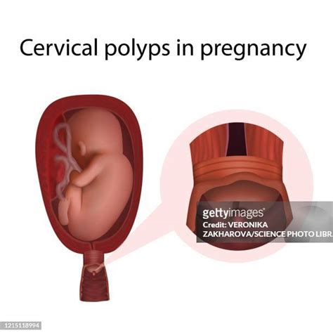 18 Cervical Polyps Stock Photos, High-Res Pictures, and Images - Getty Images