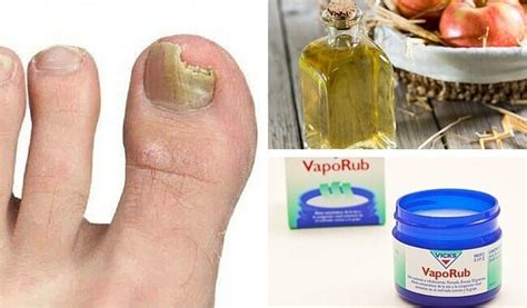 6 simples remedios para eliminar los hongos de las uñas Mejor con Salud