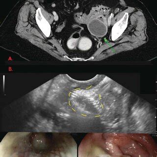 Diverticular abscess with EUS-guided drainage and LAMS placement. A, A... | Download Scientific ...