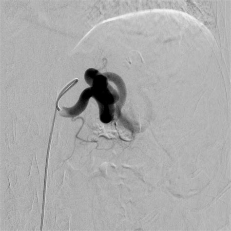 Tf Visceral Embolization Case Albany Ir