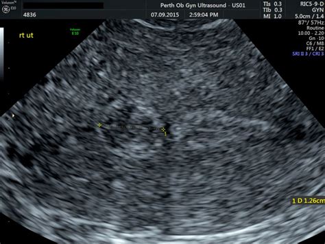 Pelvic Ultrasound - POGU