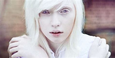 Albino Person Red Eyes