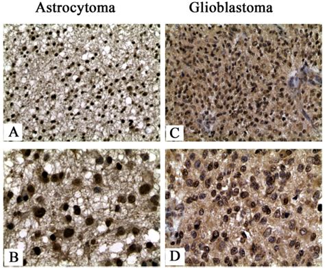 P423 Expression In Astrocytomas And Glioblastomas Evaluated By