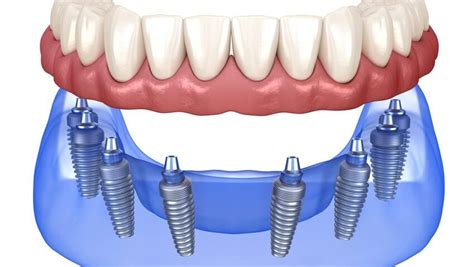 Tarifs Implants Dentaires All On 8 En Tunisie Prix Tout Compris