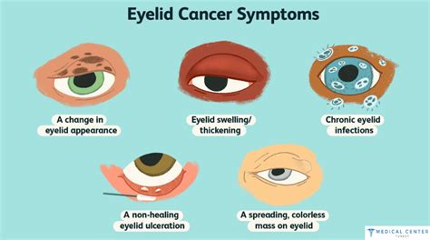 Eye Cancer - MCT