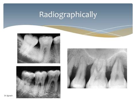 Furcation Involvement