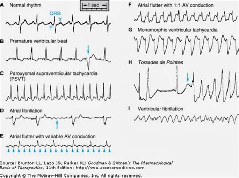 Abnormal Heart Rhythm Charts