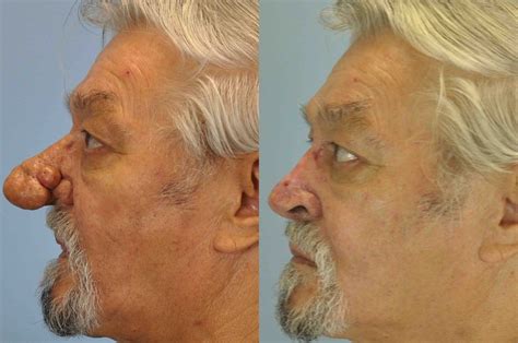 Nose Surgery Gallery Dr Paul Vanek MD