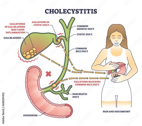 Fototapeta Kuchenna Cholecystitis As Gallbladder Inflammation From