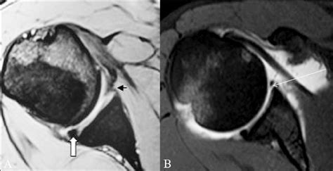 Bankart Lesion Mri