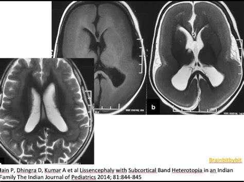 Lissencephaly Mri