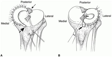 Meniscal Allograft Transplantation Jaaos Journal Of The American