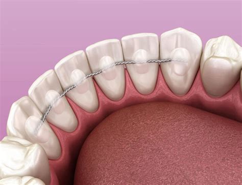 Fixed Retainer Post Insertion Instructions Atlas Dental