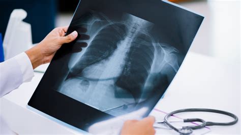 Raio X Do Torax Detecta Quais Doenças - Raio-X de tórax: quais doenças pulmonares podem ser identificadas por ...