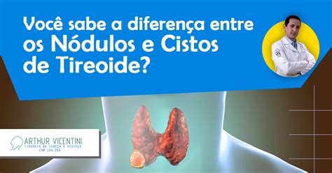 Diferença De Nodulo E Cisto - Você Sabe A Diferença Entre Os Nódulos E Cistos De Tireoide? - Dr ...