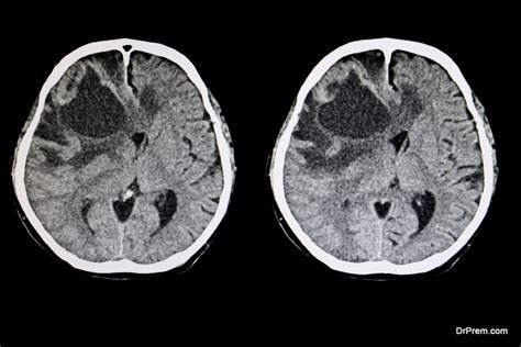 9 Essential Cerebral Edema Treatment Guidelines